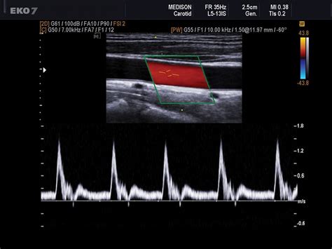 Doppler Ultrasound Of The Carotid Arteries Ultrasound School