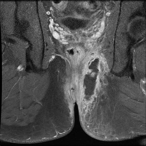 Perianal Abscess Image