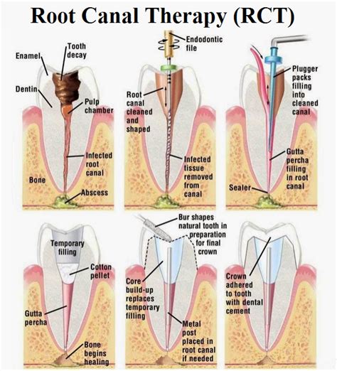 We did not find results for: Root Canal Treatment | News | Dentagama