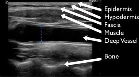 Pocus For Soft Tissue Cellulitis Abscess Nec Fasc Foamed Foamus Meded Ultrasound