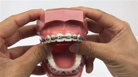 How To Close Gap In Teeth With Braces Reverasite