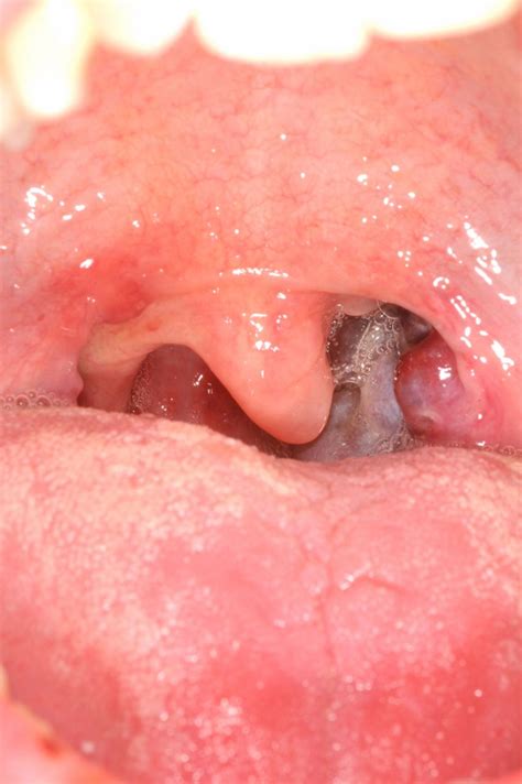 Kaposis Sarcoma Of The Tonsils Bmj Case Reports