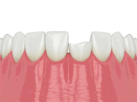 5 Solutions For Fixing A Chipped Or Broken Tooth Smile Restoration
