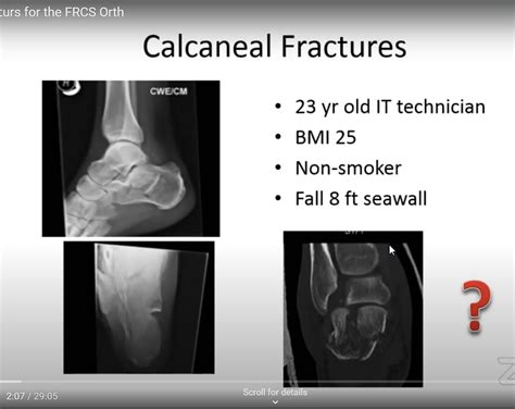 Calcaneus Fracture Types