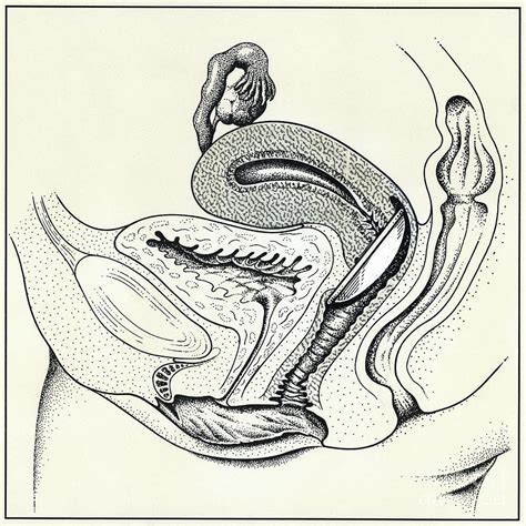 Diaphragm Contraceptive In The Uterus Photograph By John Bavosi Science Photo Library Fine Art