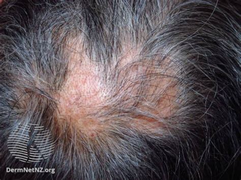 The Connection Between Celiac Disease And Hair Loss