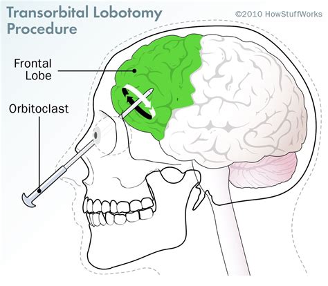 Soul Surgery Successes And Failures In Lobotomy Patients Lobotomy