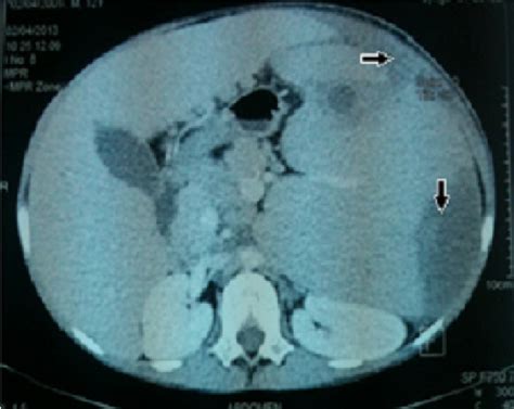 Abdominal Ct Scan Showing The Liver And Spleen Enlargement With Splenic