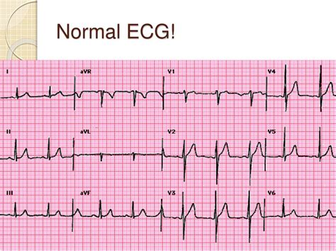 Electrocardiogram Interpretation Gambaran
