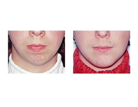 Case Study Correction Of Bony Chin Asymmetry Explore Plastic Surgery