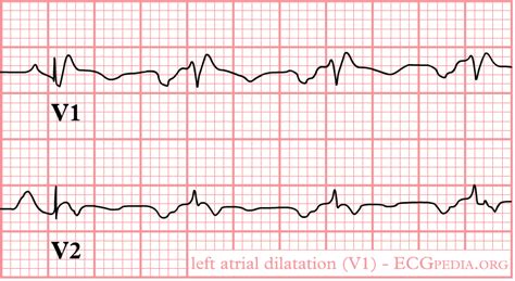 Left Atrial Enlargement Electrocardiogram Wikidoc