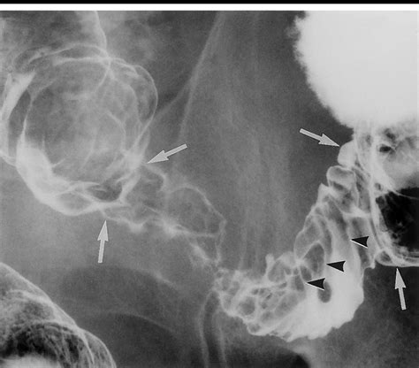 Right Anterior Oblique Double Contrast Barium Enema Radiograph Of