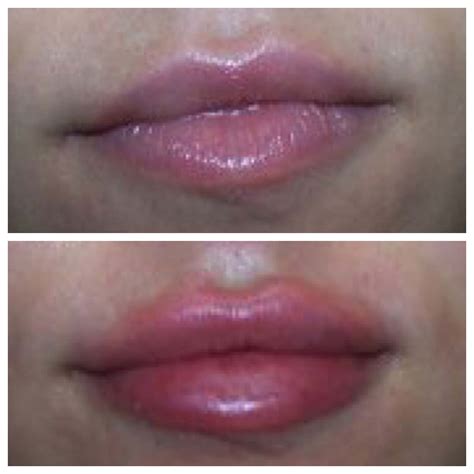 Juvederm ultra plus is a hyaluronic acid filler that i frequently use in areas needing additional lift or projection than what juvederm ultra can provide. Juvederm® Ultra Plus | Radiance Medspa | Hartford CT | Avon CT