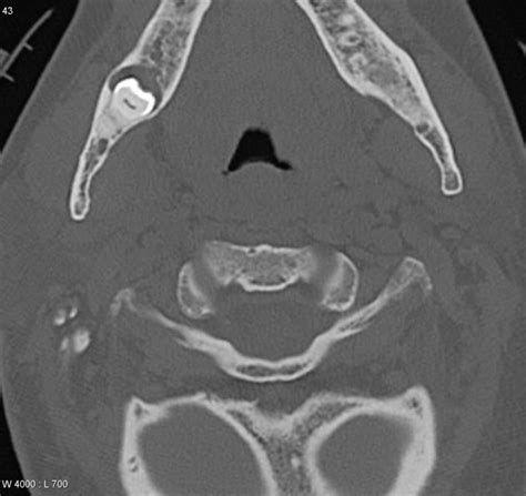 Dentigerous Cyst Radiology Reference Article