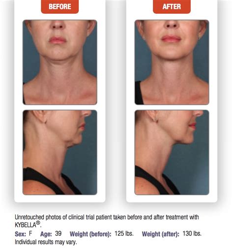Kybella Treatments At Laser Skin Institute Chatam New Jersey