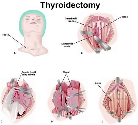 Thyroidectomy Partial Or Total Thyroidectomy Recovery Complications