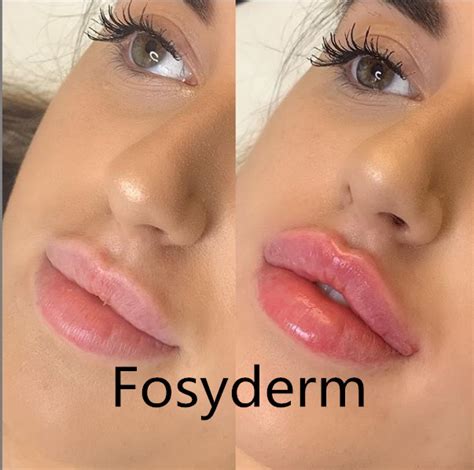 24mg Ml Ultra4 Injectable Hyaluronic Acid Gel Dermal Filler For Lips