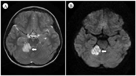 T2 And Diffusion Weighted Magnetic Resonance Imaging Of The Brain