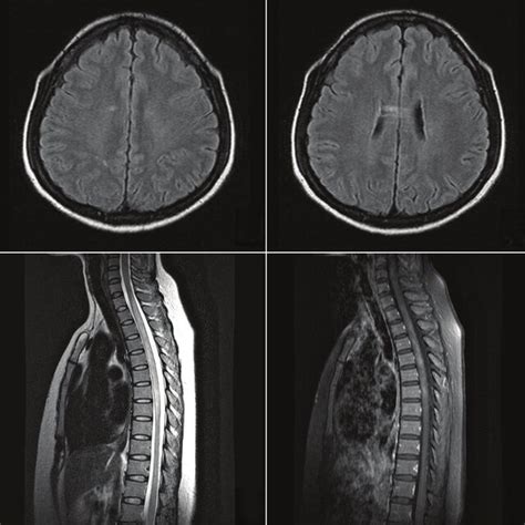 Figure Brain And Spinal Mris Of The Patient Brain Mri Flair Shows