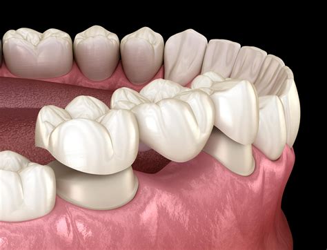 Porcelain Crowns And Bridge Pure Bliss Dental Care