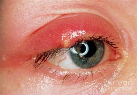 Stye On Upper Eyelid Photograph By Western Ophthalmic Hospitalscience