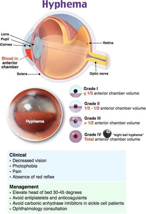 Pin By Julie Winegeart On Ophthalmic Technician Eye Health Facts