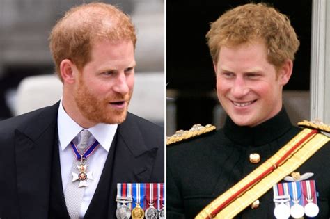 Receding Prince Harry Will Be Completely Bald By Age 40 Hair
