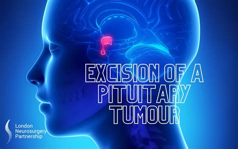 Excision Of A Pituitary Tumour London Neurosurgery
