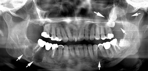 Multiple Jaw Cysts And Ectopic Calcification Bmj Case Reports