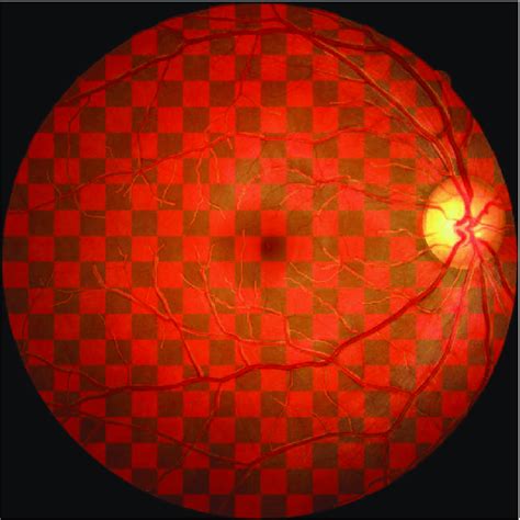 Retinal Image With Checkerboard Patchwork Simulating Carrier Female Download Scientific Diagram