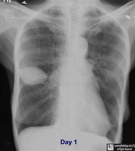 Encysted Pleural Fluid Right Side Radiology Medical Thoracic