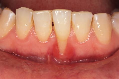 Gum Recession Treatment River Valley Periodontics Implant Dentistry