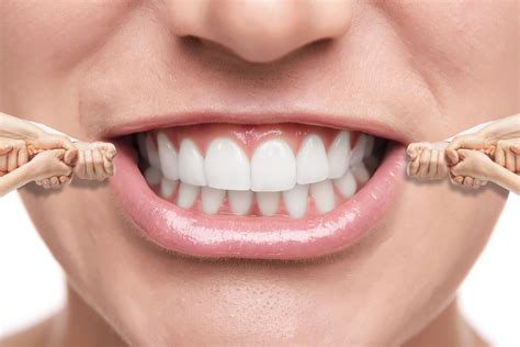 Learn more about our different braces and how much they cost braces are effective in correcting a wide variety of conditions and provide an array of benefits. Pros and Cons to Invisalign | Tenniswood Dental Associates