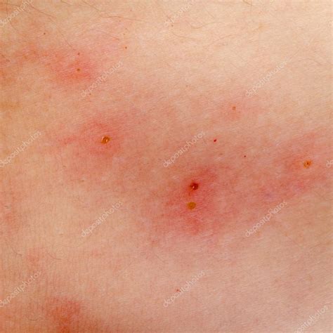 Allergic Rash Dermatitis Eczema Skin — Stock Photo © Panxunbin 17995659
