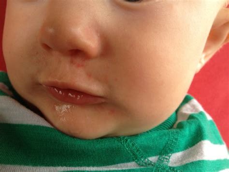 Rash Around Nose And Mouth Pic Page 1 Babycenter