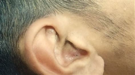 Newest Massive Big Blackheads In Ear Full Extraction Official Video