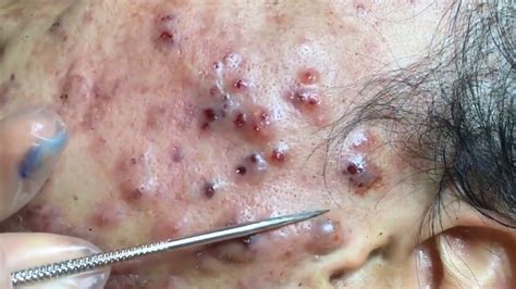 Satisfying Pimple Popping Videos Cystic Acne Youtube