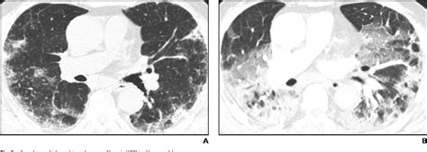Figure 5 From Idiopathic Pulmonary Fibrosis Spectrum Of High