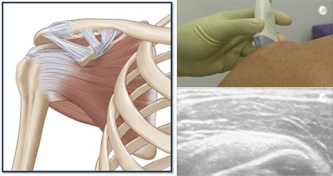 May 2014 PRP In Shoulder Injury Tendinopathy Rotator Cuff Tear And