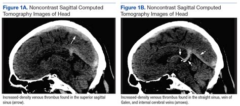 Cerebral Venous Thrombosis Federal Practitioner