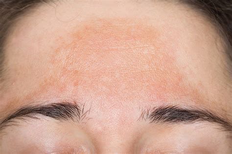 Skin Pigmentation Brown Patches