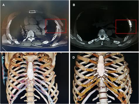 Ct Scan Images Of A Patient With Rib Fracture The Same Patient As