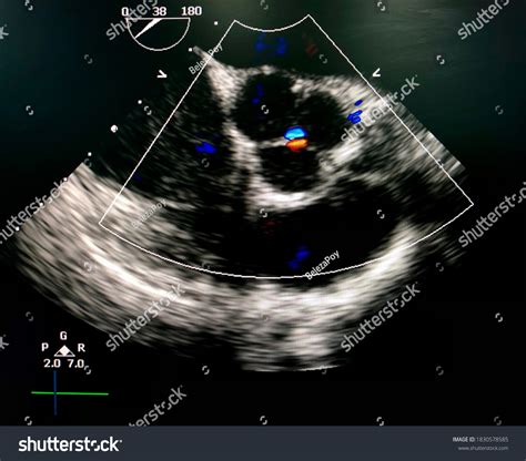 Transesophageal Echocardiogram Tee Shown Aortic Valve Stock Photo