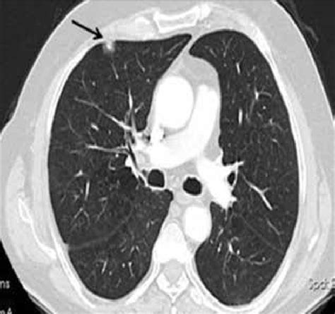 A Mm Diameter Pulmonary Nodule With Subpleural Placement In The