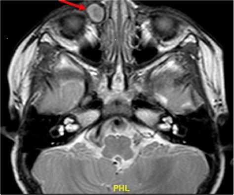 Dermoid Cyst Simulating Recurrent Dacryocystitis In A Toddler