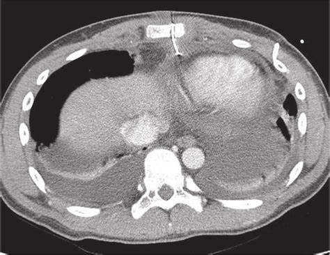Axial Image Of Contrast Enhanced Chest Ct Shows Fractured Sternal Wire