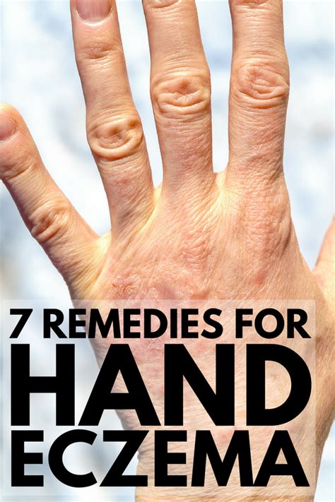 How To Cure Hand Eczema Looking For Natural Cures To Help Get Your