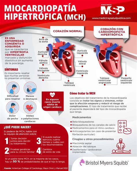 Miocardiopatía hipertrófica Infografía