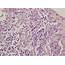 Severe Inflammatory Reaction Of The Neutrophils Histiocytes And 