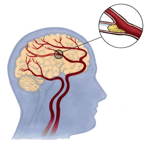 Trombos — s ( en, er) med blodpropp. Blodpropp i hjernen - - NDLA